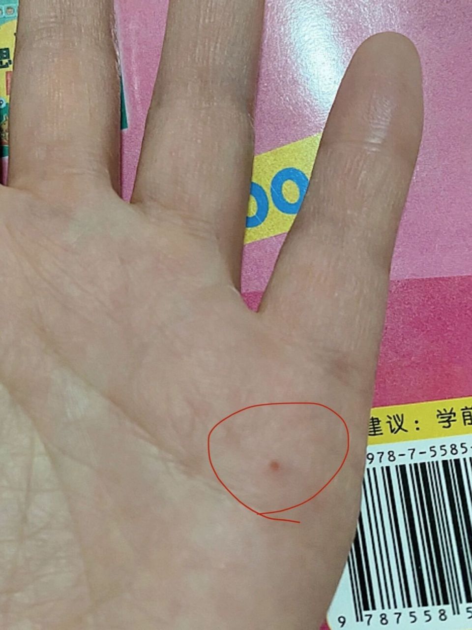 手上有个无法愈合的伤口 不知道从什么时候起,手上这个口子一直长不到