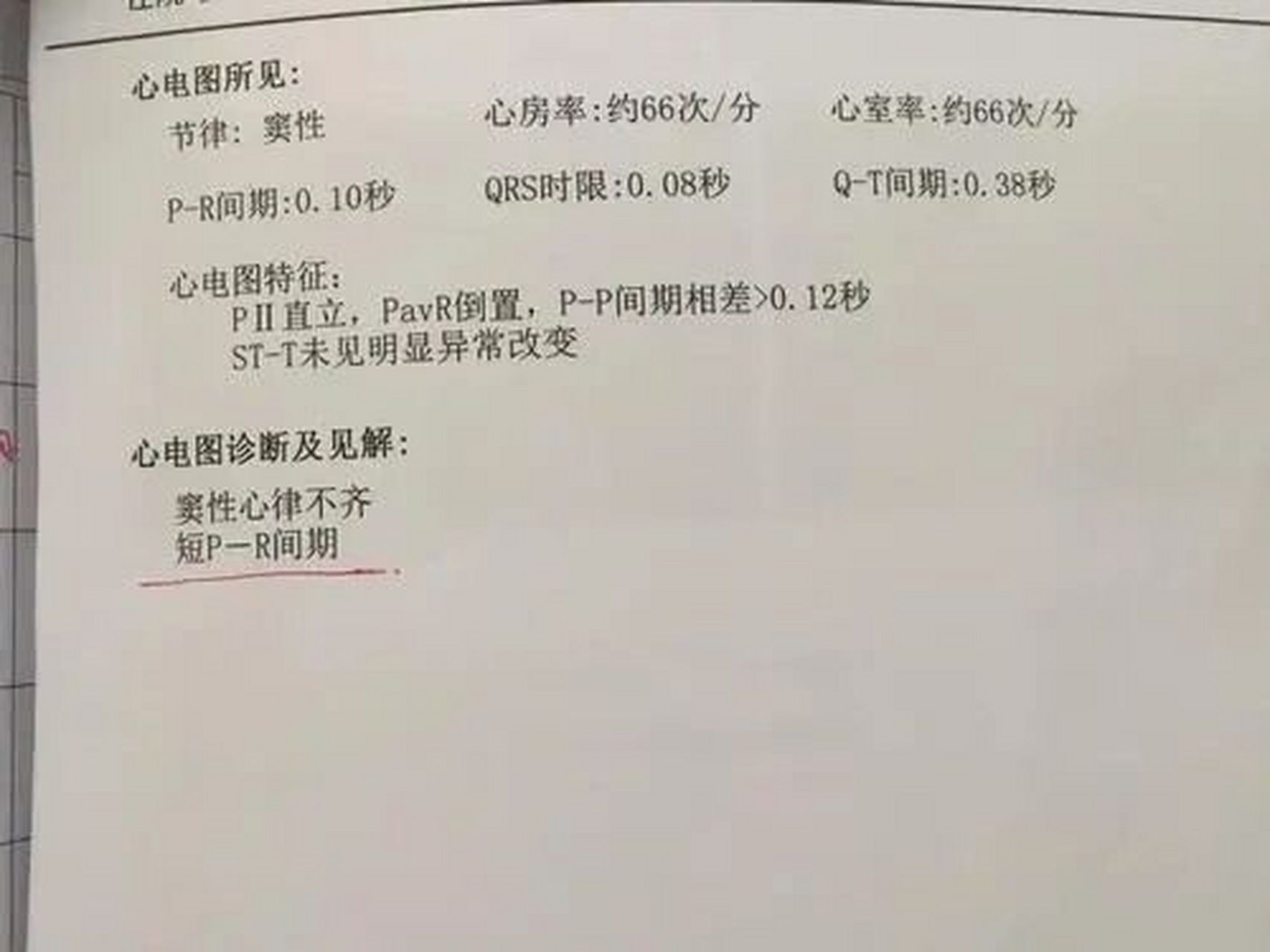 今天我跟大家说说什么是窦性心律不齐.