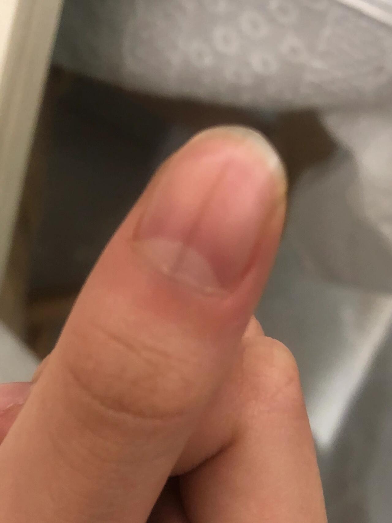 指甲上的竖线