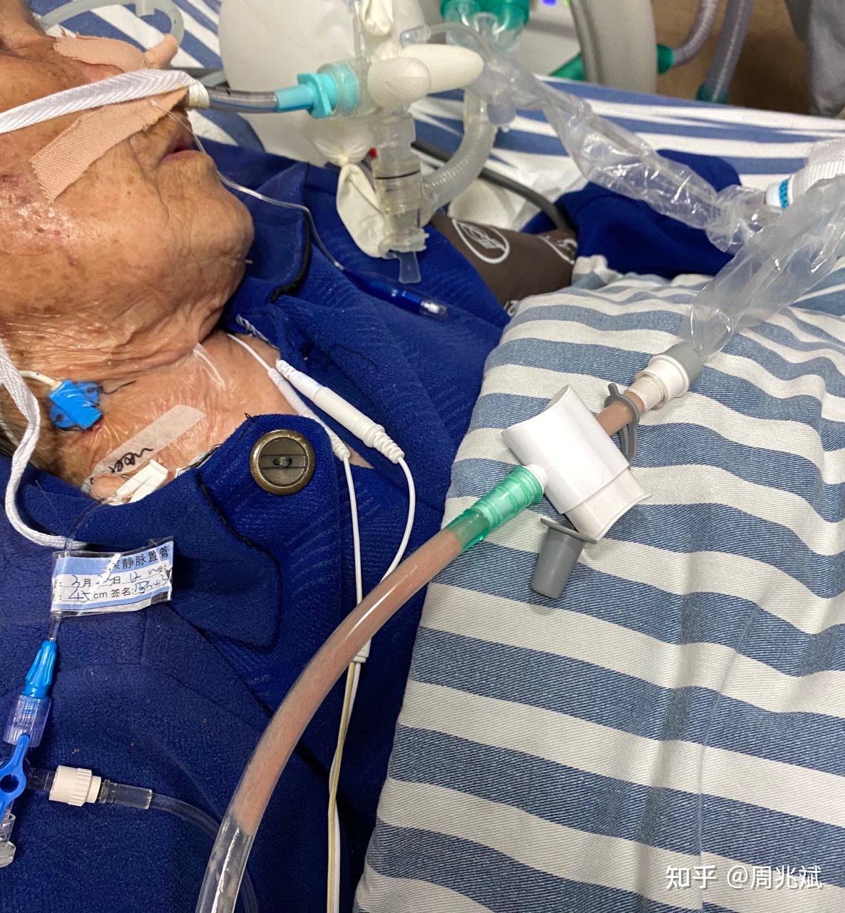 气管插管是什么感觉有用的过的么是不是肺部凉凉的还有其他不一样的