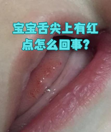 宝宝舌尖有红点可能和微量元素缺乏,舌乳头发炎或猩红热有关