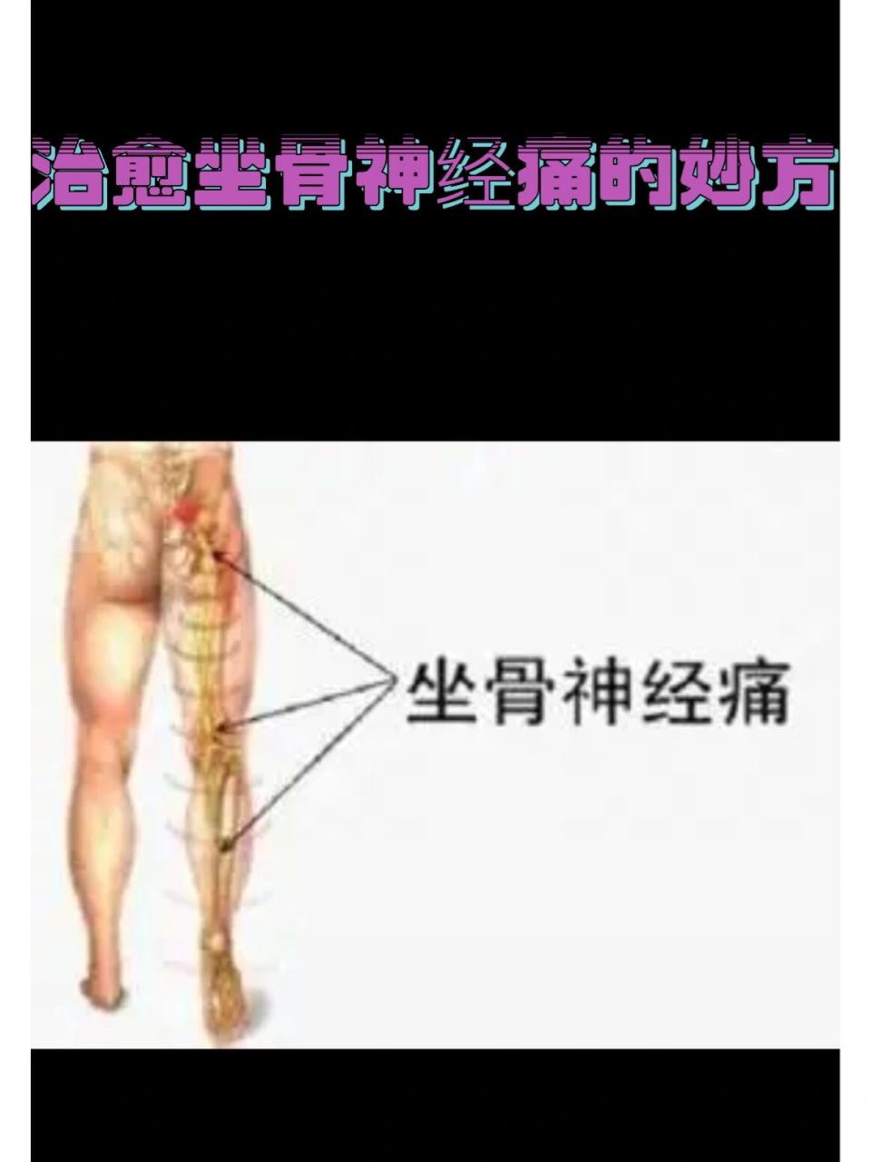 治愈坐骨神经痛的秘方 说明:此处方治愈坐骨神经痛患者,过数百例之多
