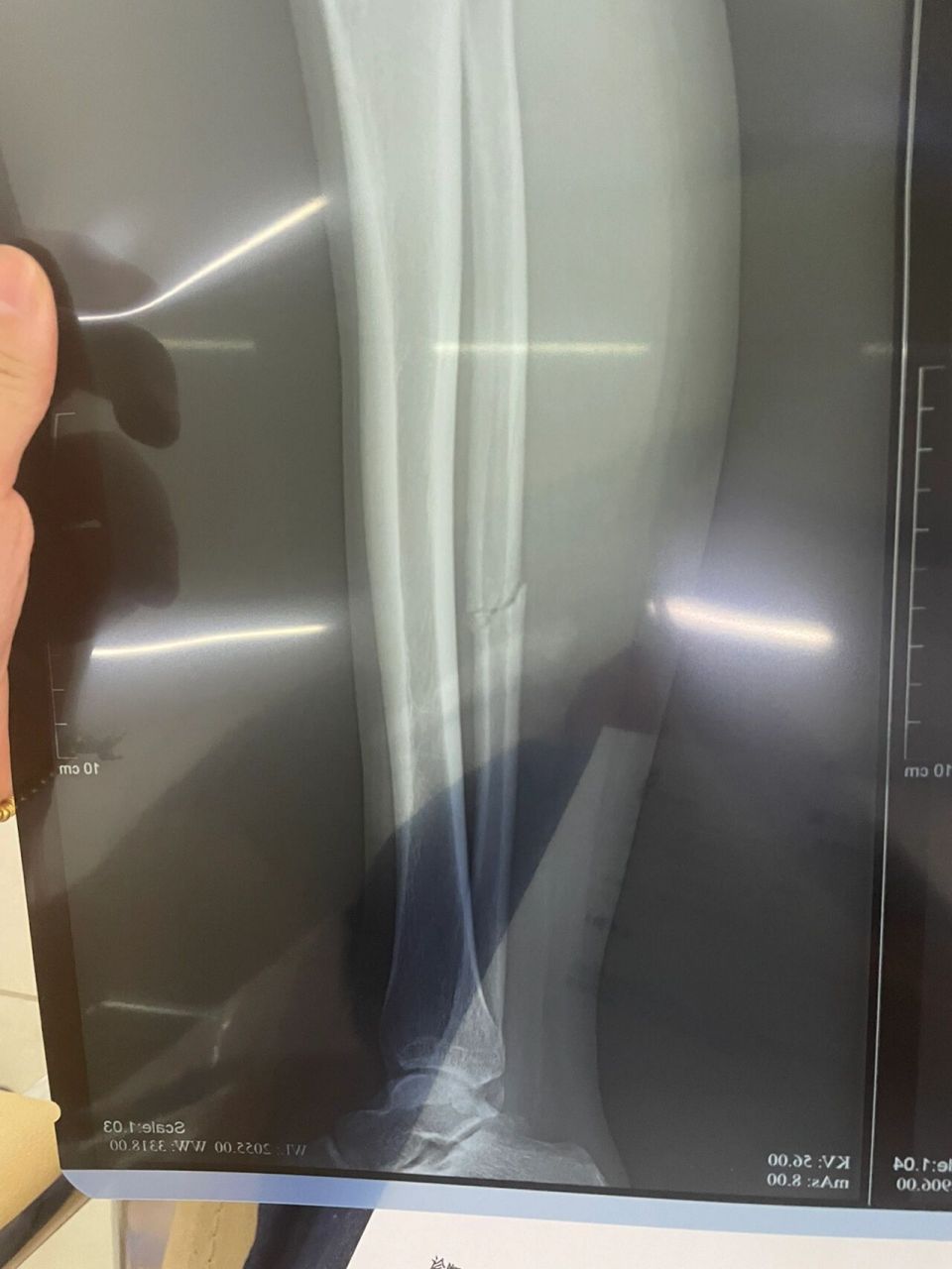 腓骨骨折 骨折两个月复查感觉还没长好,怎么这么慢?