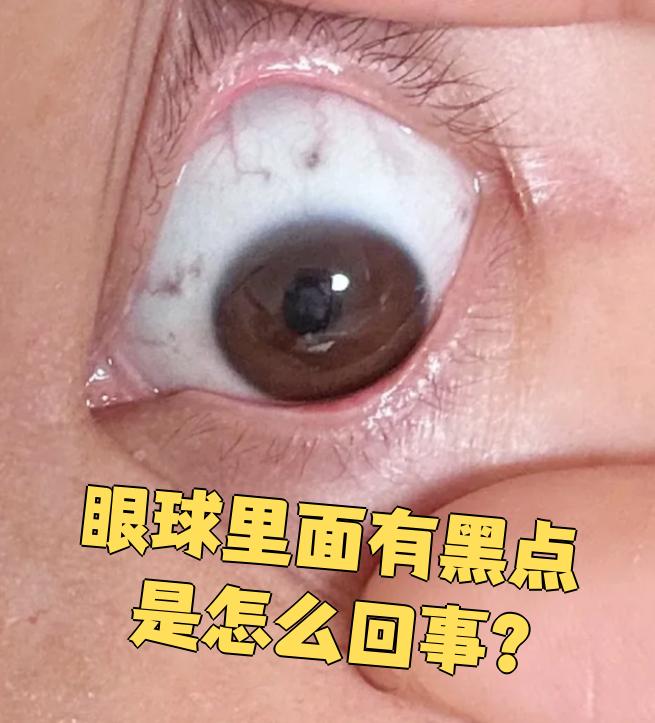 眼球里出现黑点常见的原因有三种:色素沉着,结膜异物或脉络膜透见