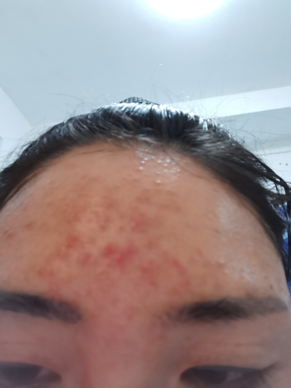 激素脸治疗面部放血治疗 刚刚交了几千块治疗面部,走了很多弯路,这次