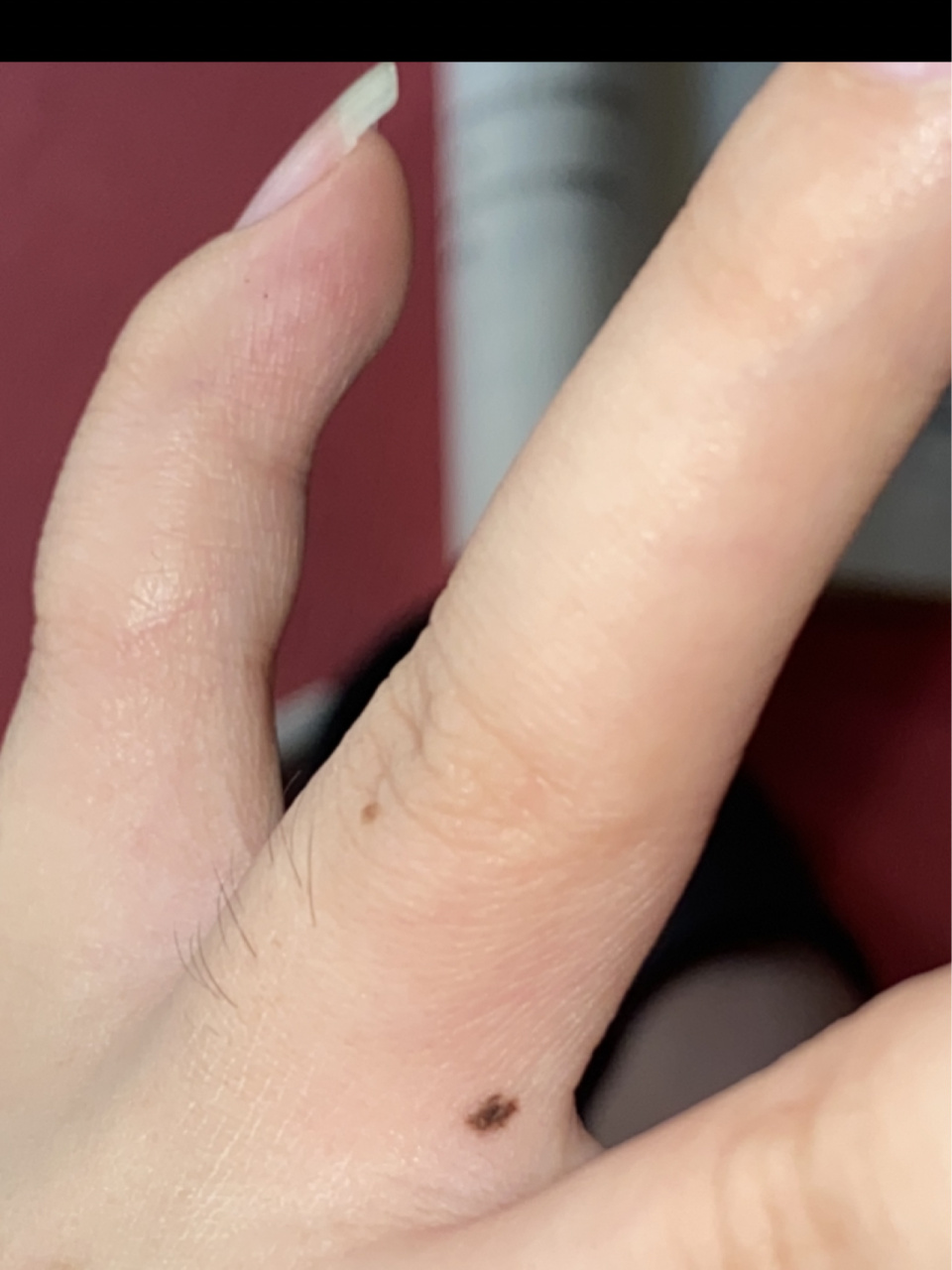 感觉手上的痣在慢慢变大 是错觉吗?