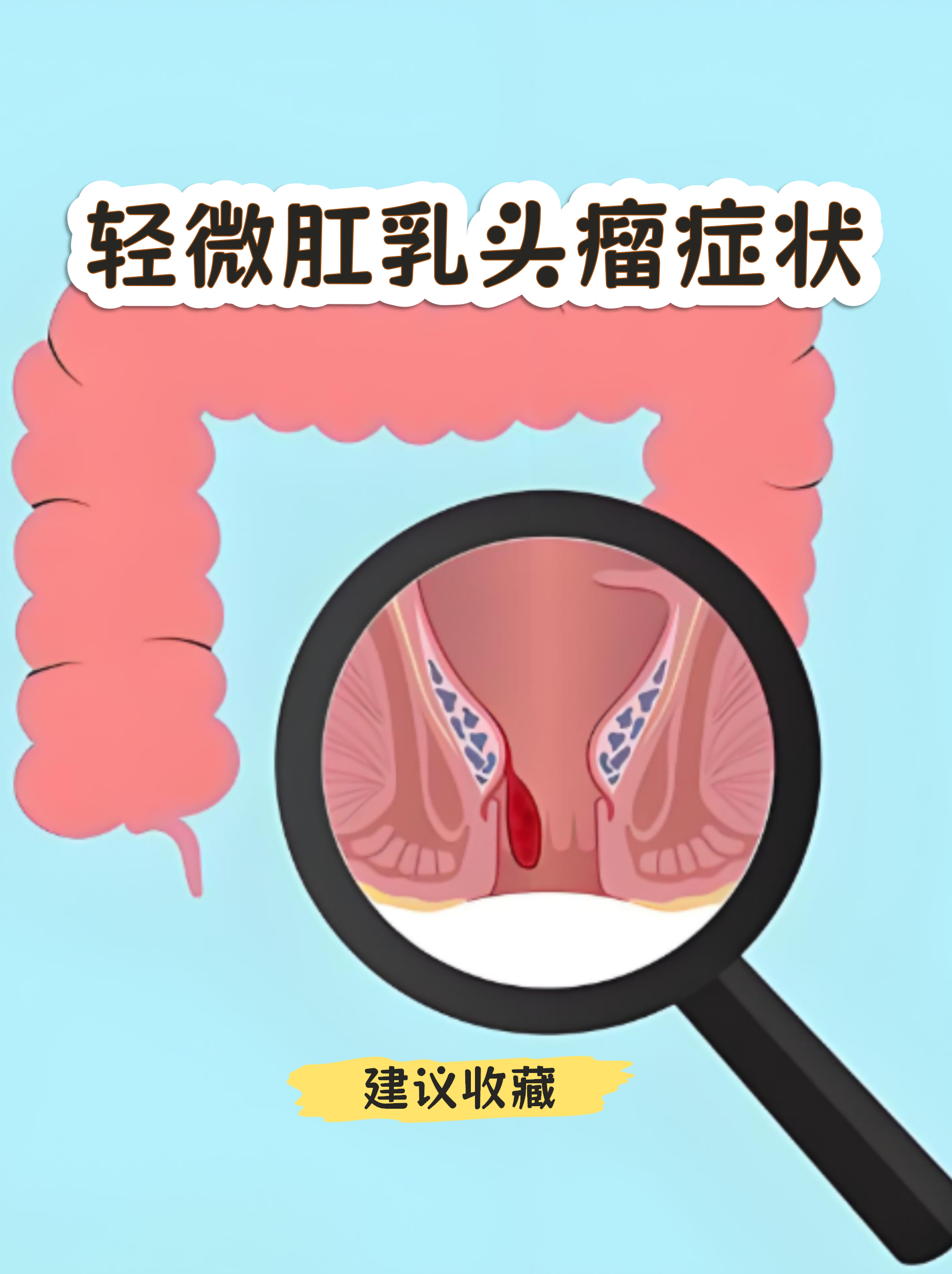 肛乳头瘤症状 肛门异物感:排便时可能感觉肛门有黄豆大小的肿物脱出