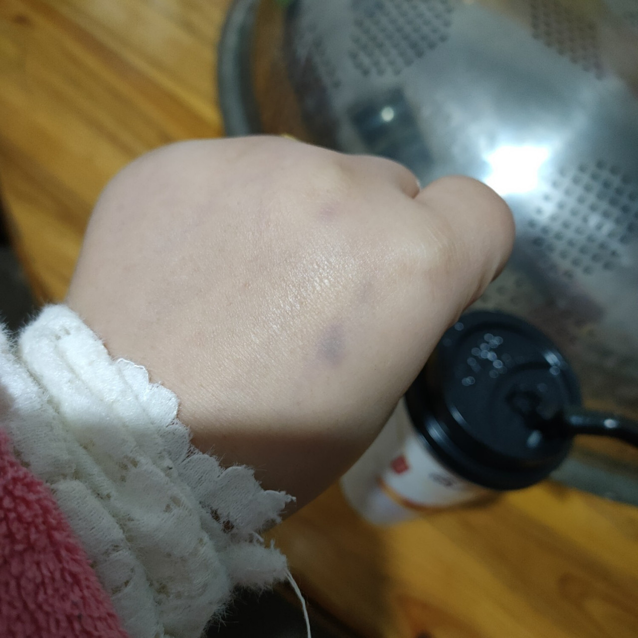 这是怎么了,手背突然出现一个淤青,不痛不痒,过一天就消失的,有谁知道