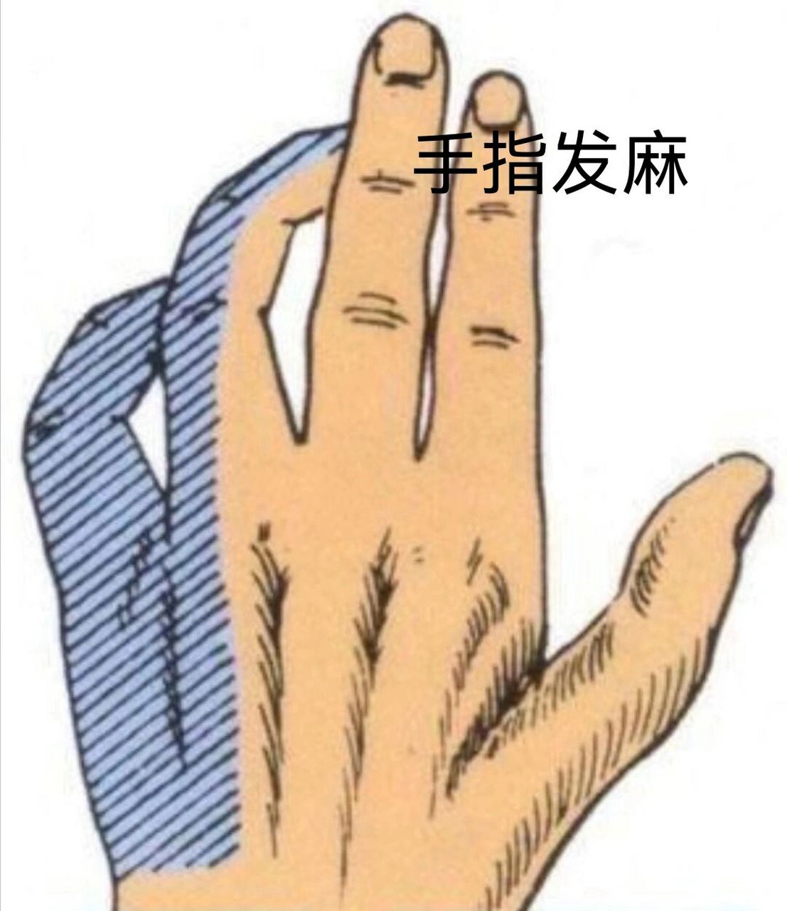 发麻多是由软组织损伤引起的,软组织损伤出现痉挛卡压刺激了支配小指