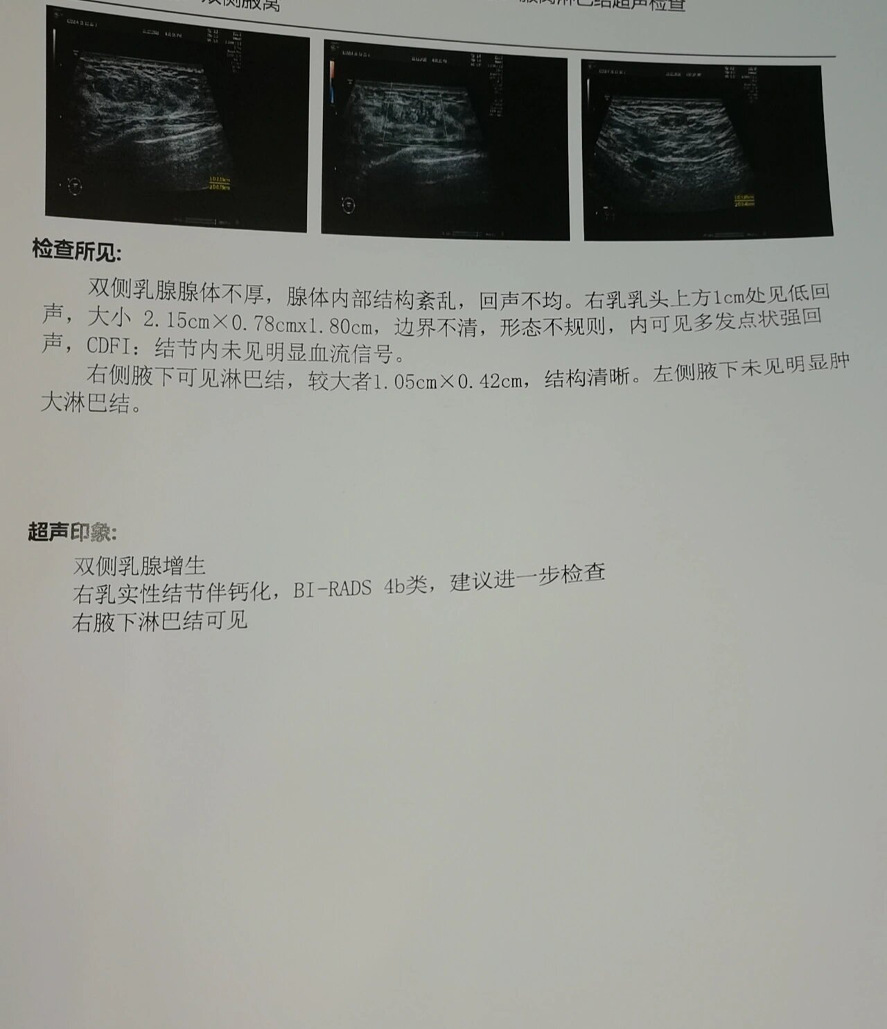 b超显示腋下有淋巴结