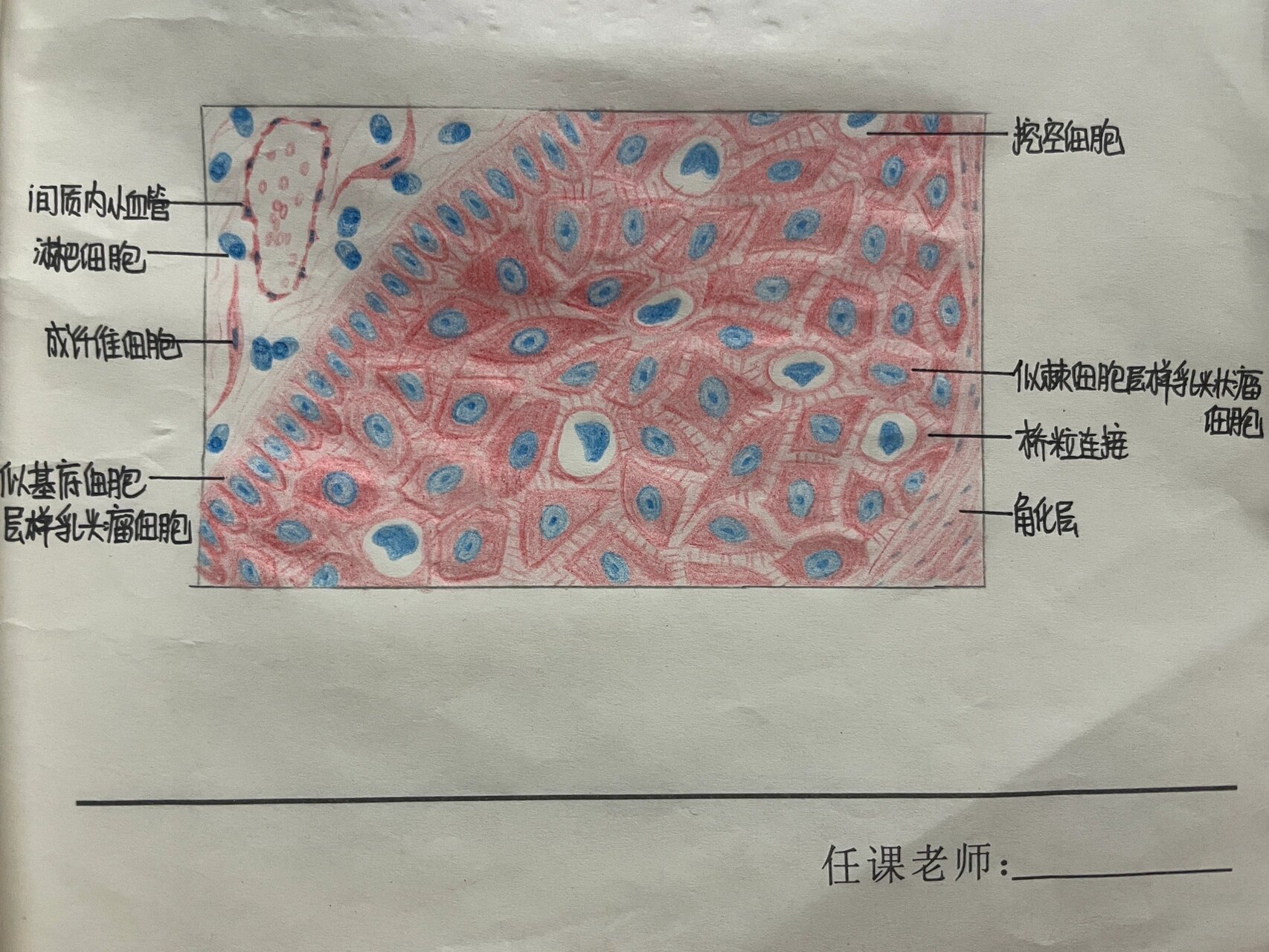 鳞状细胞癌绘图图片