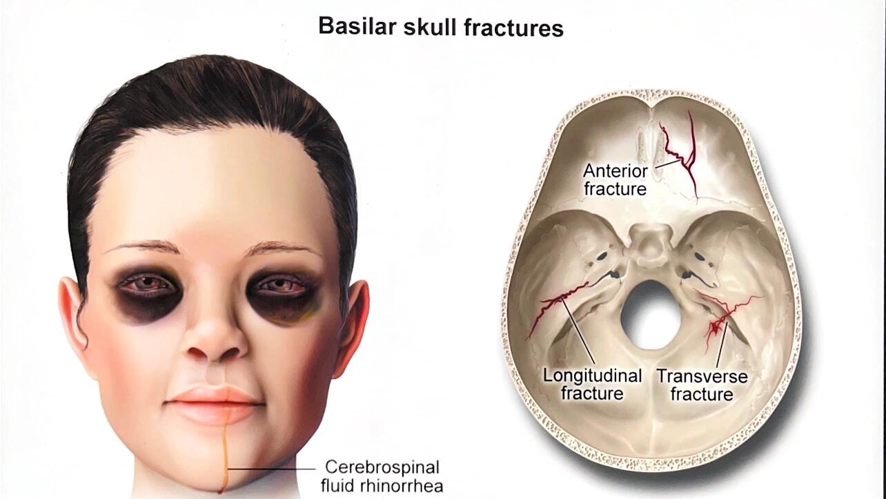 熊猫眼颅底骨折图片图片