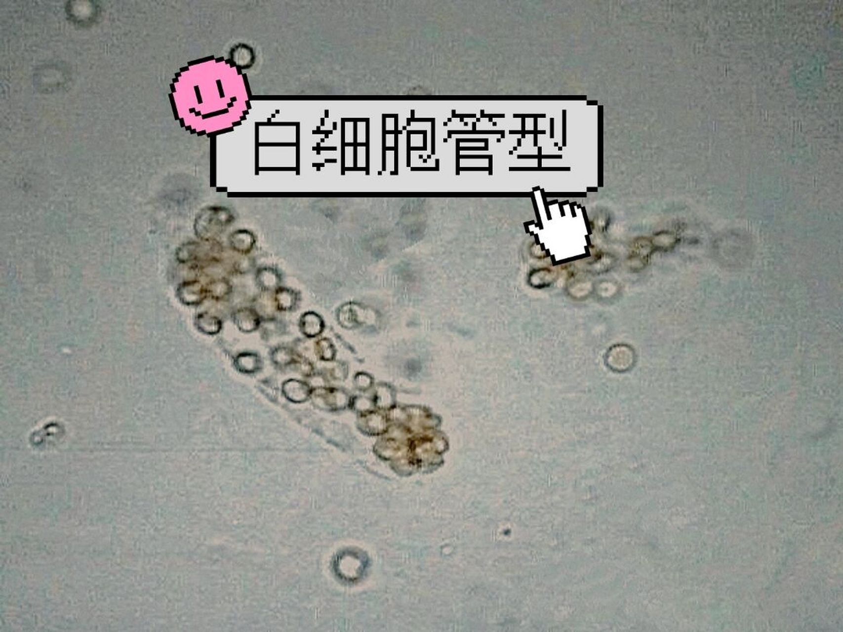 [尿镜检]白细胞管型红细胞管型傻傻分不清 94把镜下白细胞和红细胞