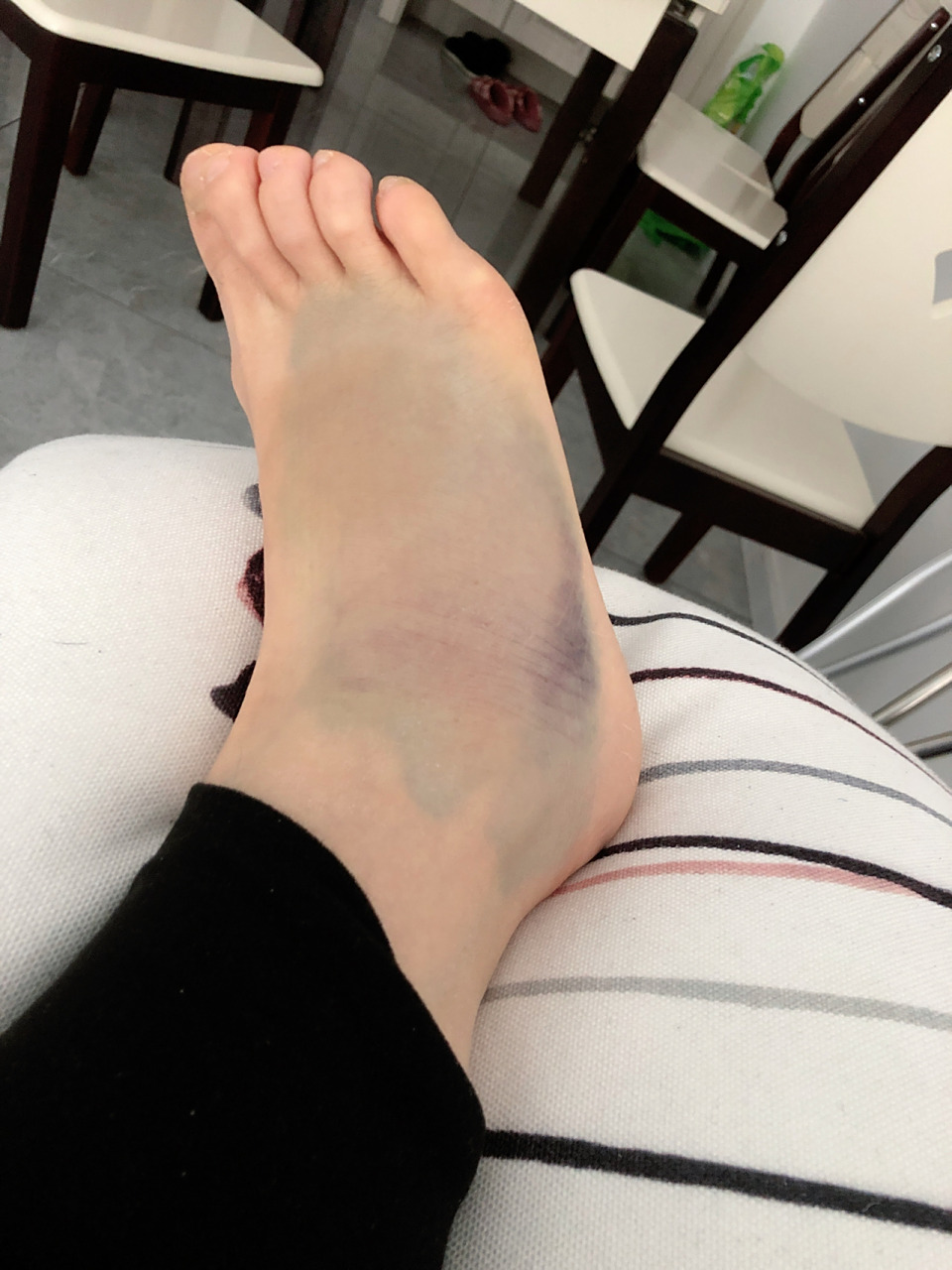 记录一下,第五跖骨基底骨折第三天,未打石膏,脚还是肿的厉害,医生建议