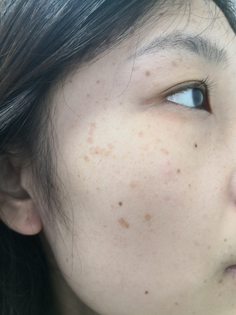 面部散发点状色素沉着过度斑点斑块.印象是色素痣和雀斑症状.