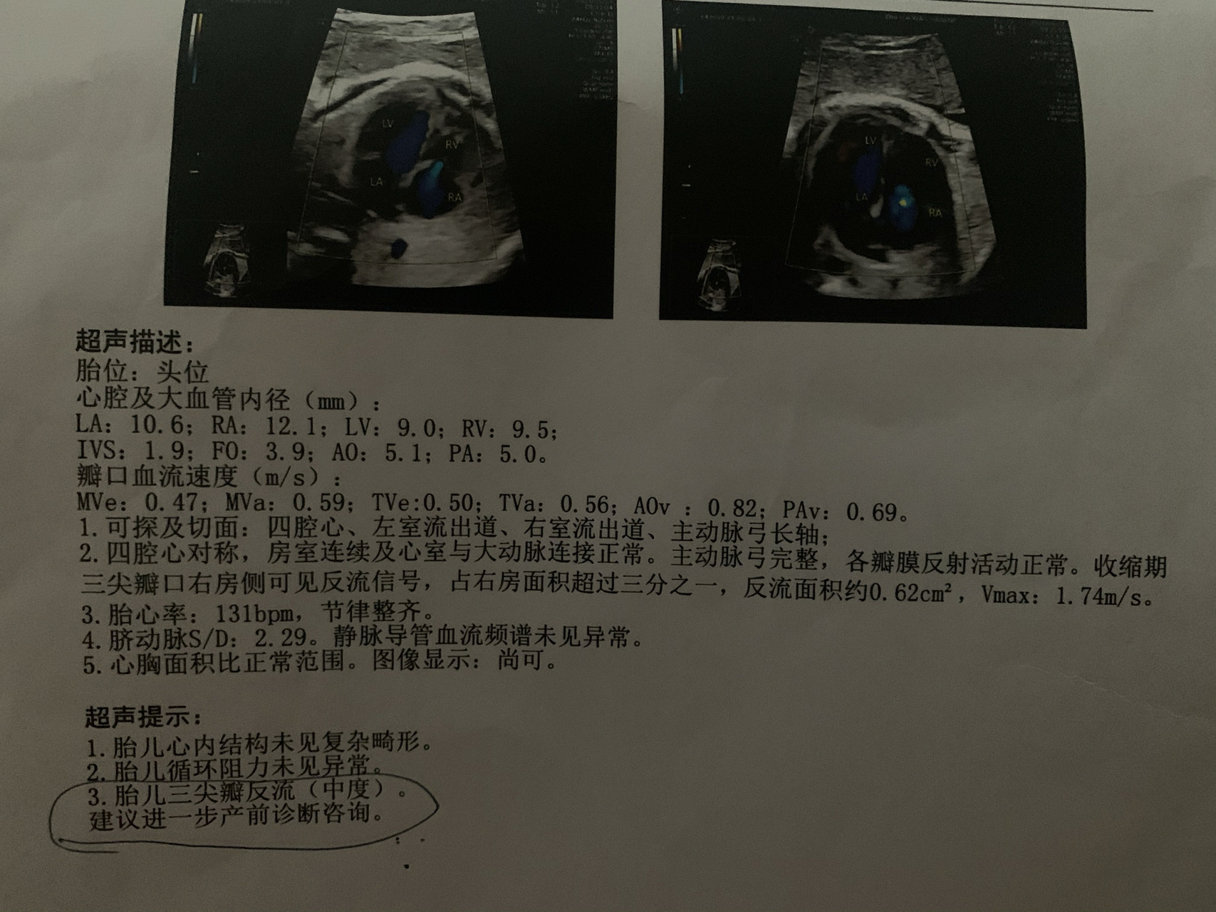 超声三尖瓣各瓣示意图图片