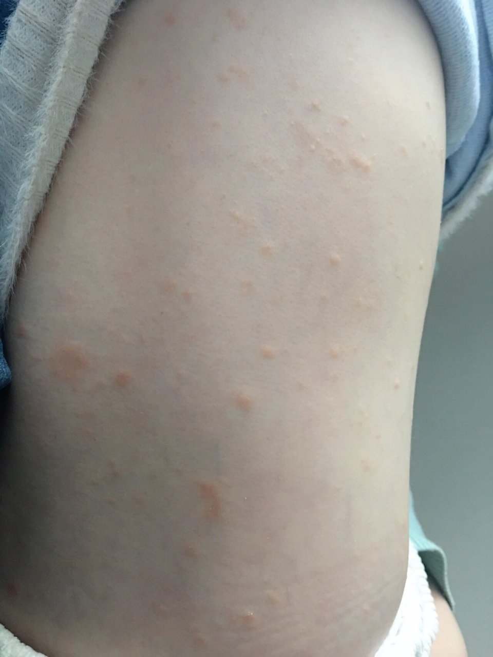 一岁八个月孩子,全身起来很多痘痘 去医院看了说是过敏性皮炎,开了几