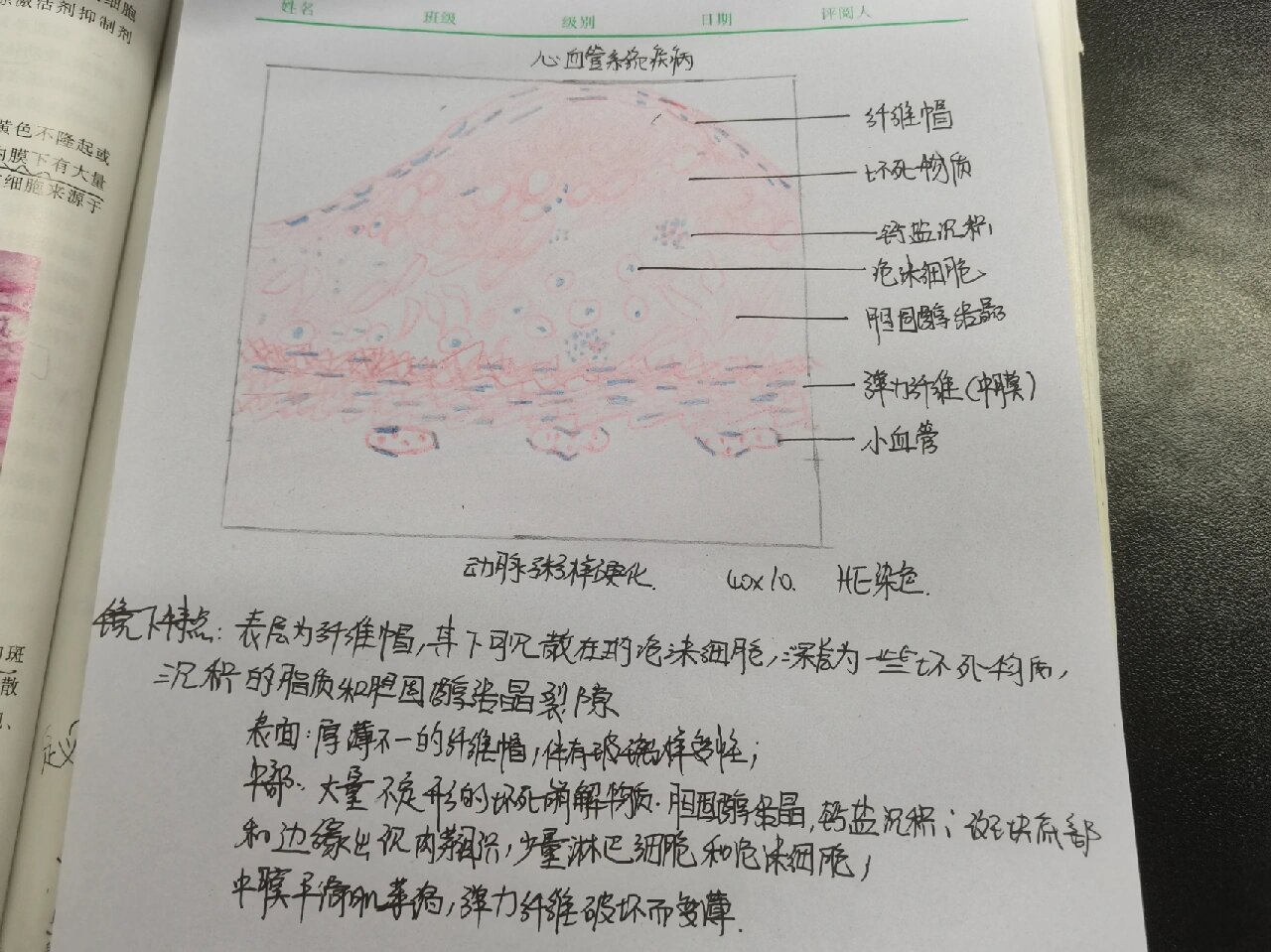 动脉粥样硬化切片图解图片