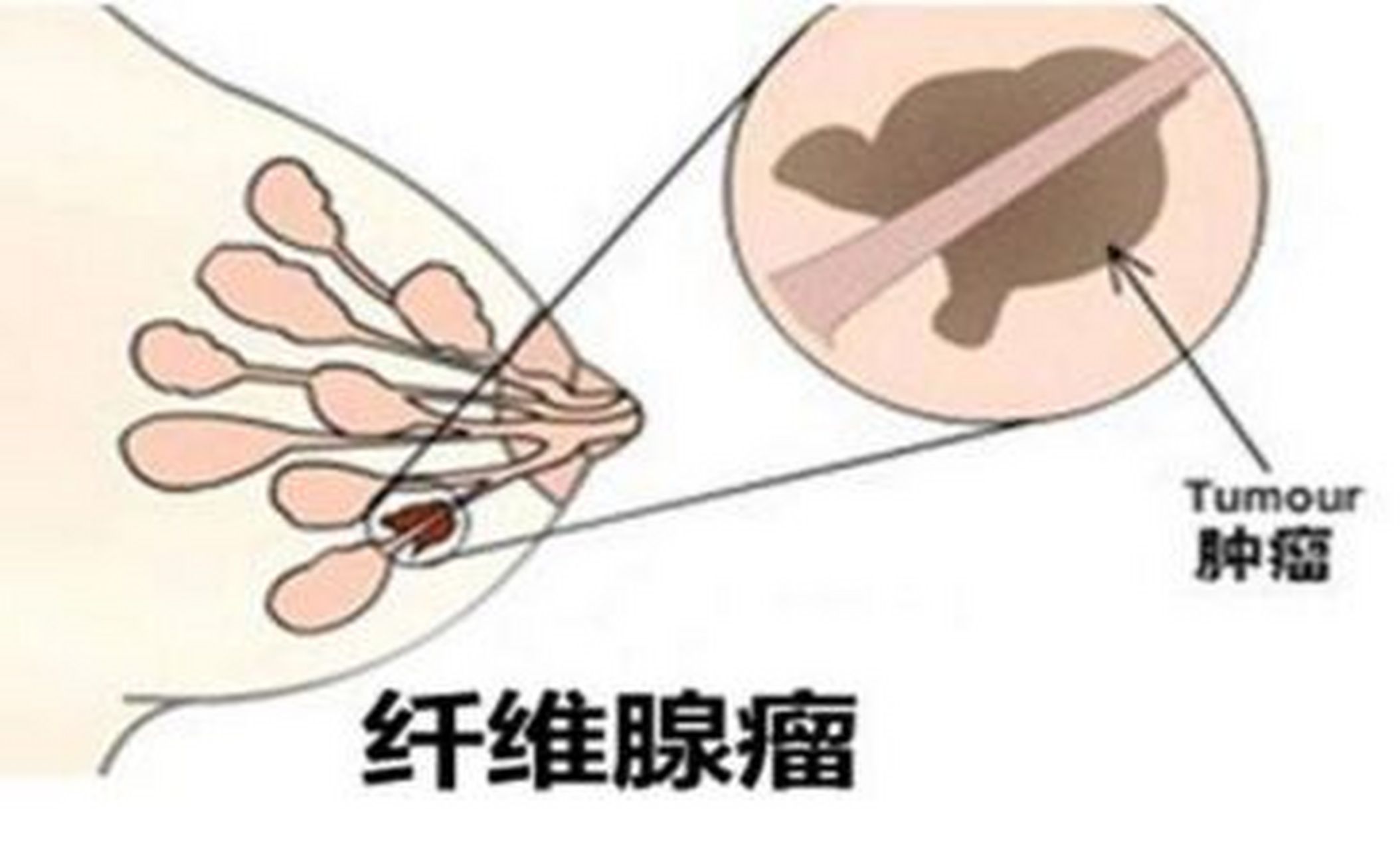 【乳腺纤维瘤形成的原因】 乳腺纤维腺瘤一般认为由于小叶内纤维细胞