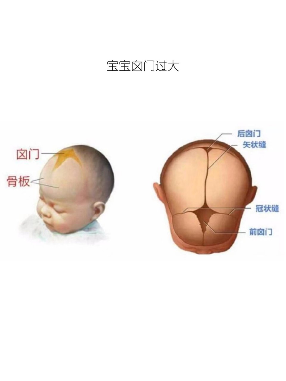 单侧冠状缝早闭图片