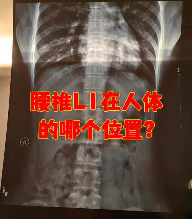 腰椎一共有5块椎体,l1就是最上面的那一块,它直接连着胸椎