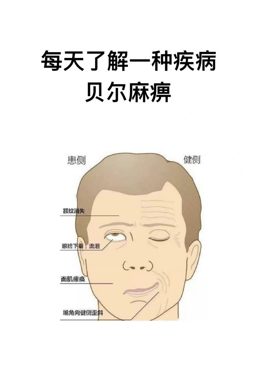 每天认识一种疾病丨贝尔麻痹 16615贝尔麻痹即bell麻痹,又称急性