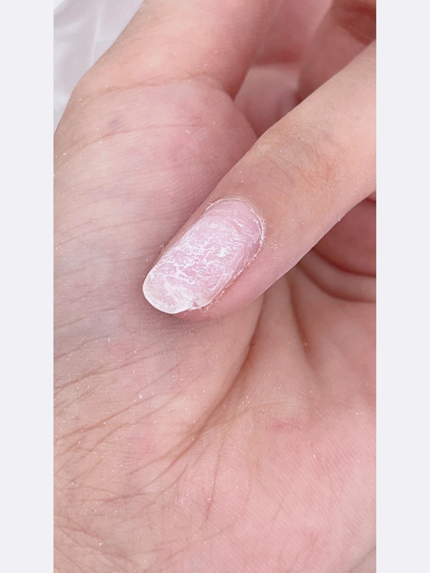 断裂,分层的本甲还可以做指甲不呢?