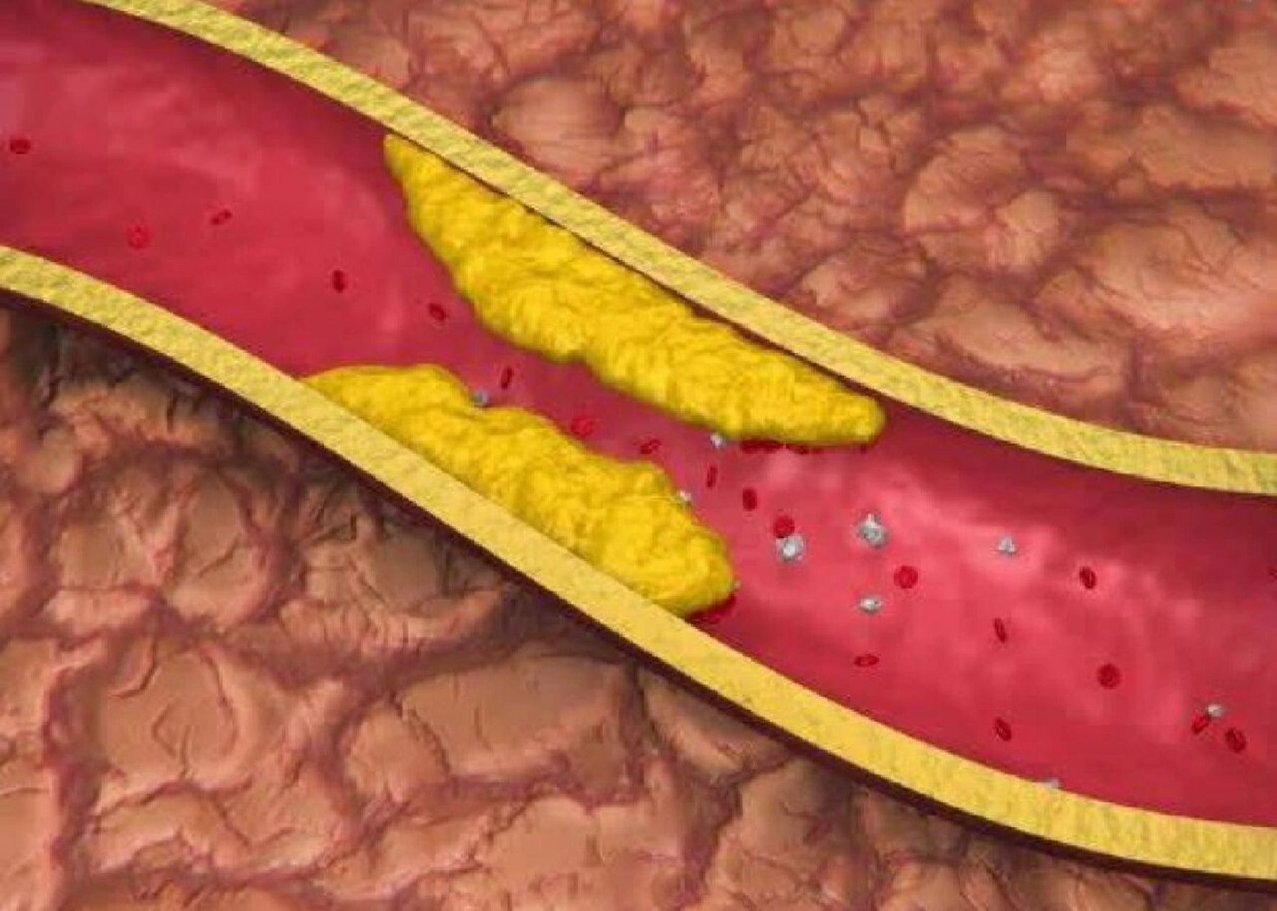 动脉粥样硬化是一种被称为"斑块"的脂肪沉积物蓄积于动脉中.