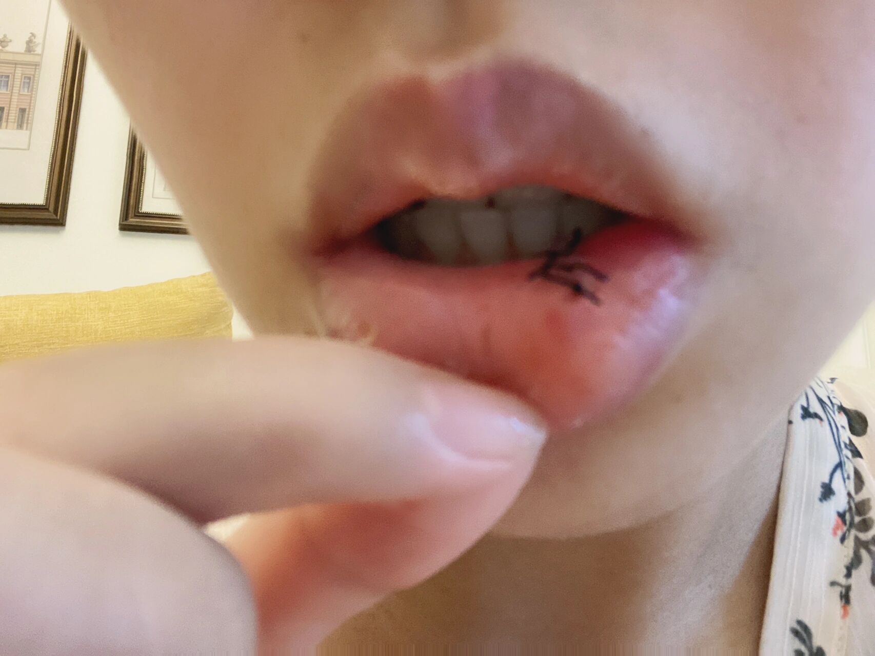 粘液腺囊肿手术