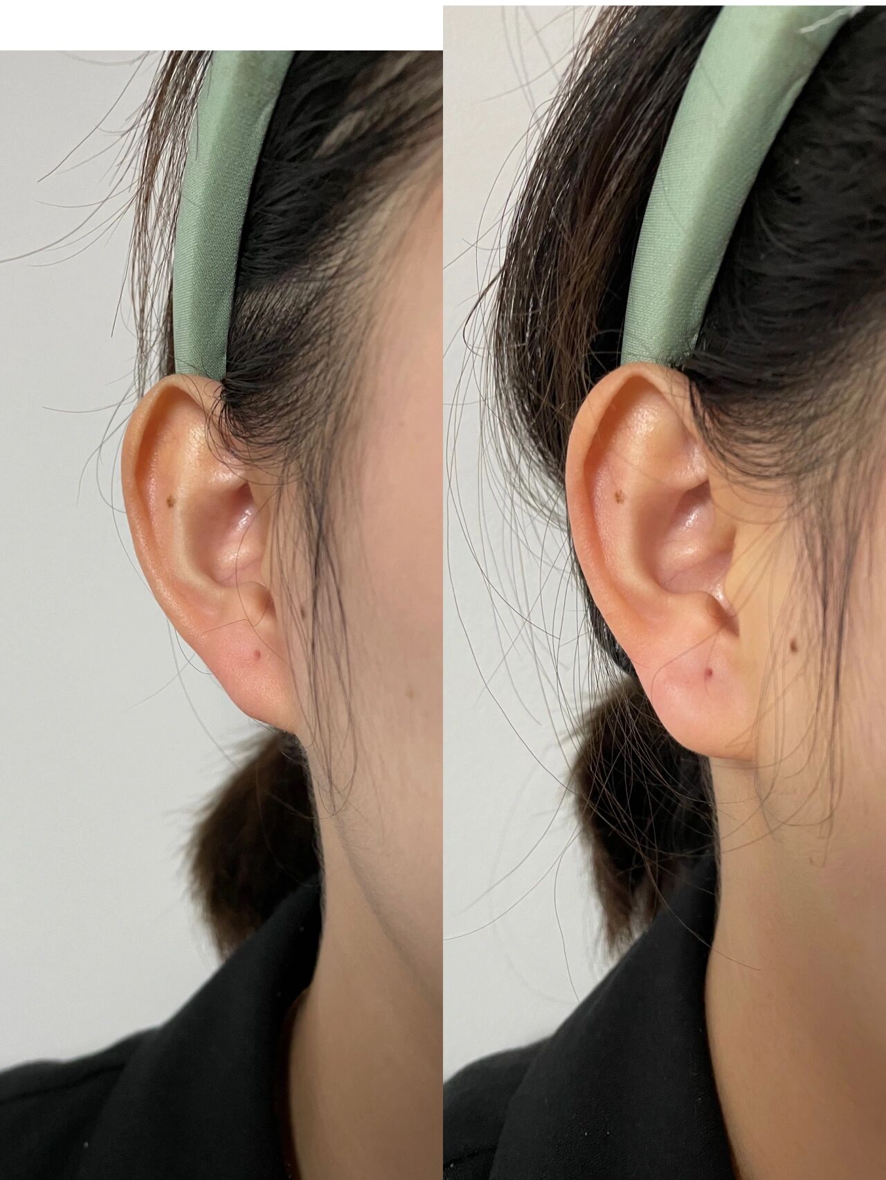 耳垂玻尿酸填充 真的是爱了 都说耳垂小没什么福气 填起来了运气都不