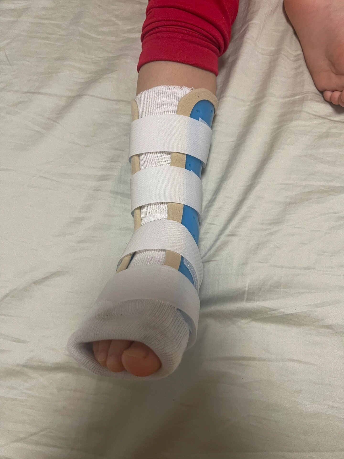 3岁儿童骨折儿研所就医经验分享 1.