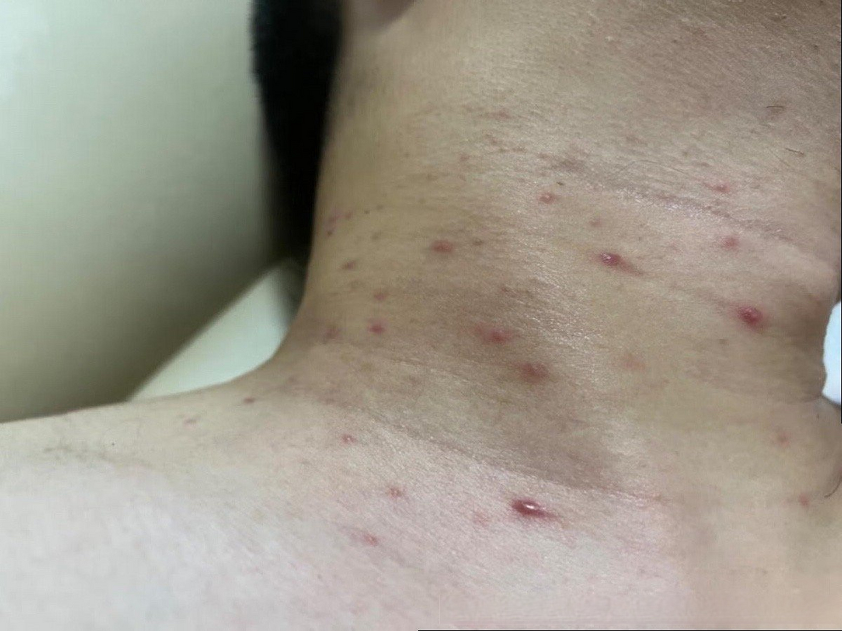 健康科普公开课# 脖子里面长了一些红疙瘩,不痛不痒,没什么感觉,撼い
