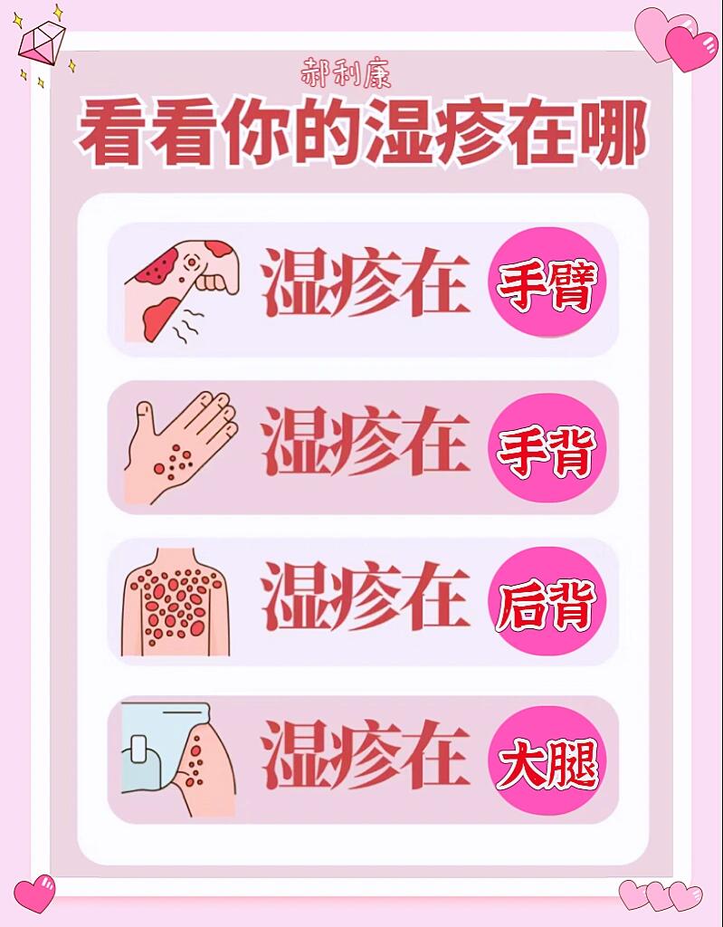 湿疹在后背 4湿疹在大腿 常见的长湿疹四大原因 1