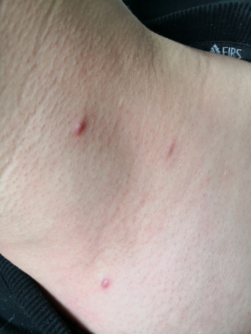 前胸颈部的瘢痕疙瘩症状#美容##解决皮肤问题专注皮肤美容##瘢痕疙瘩