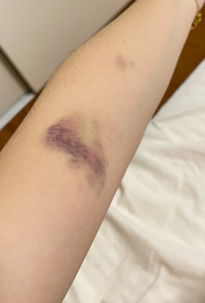 手臂被打紫青后,可以先用冷敷处理