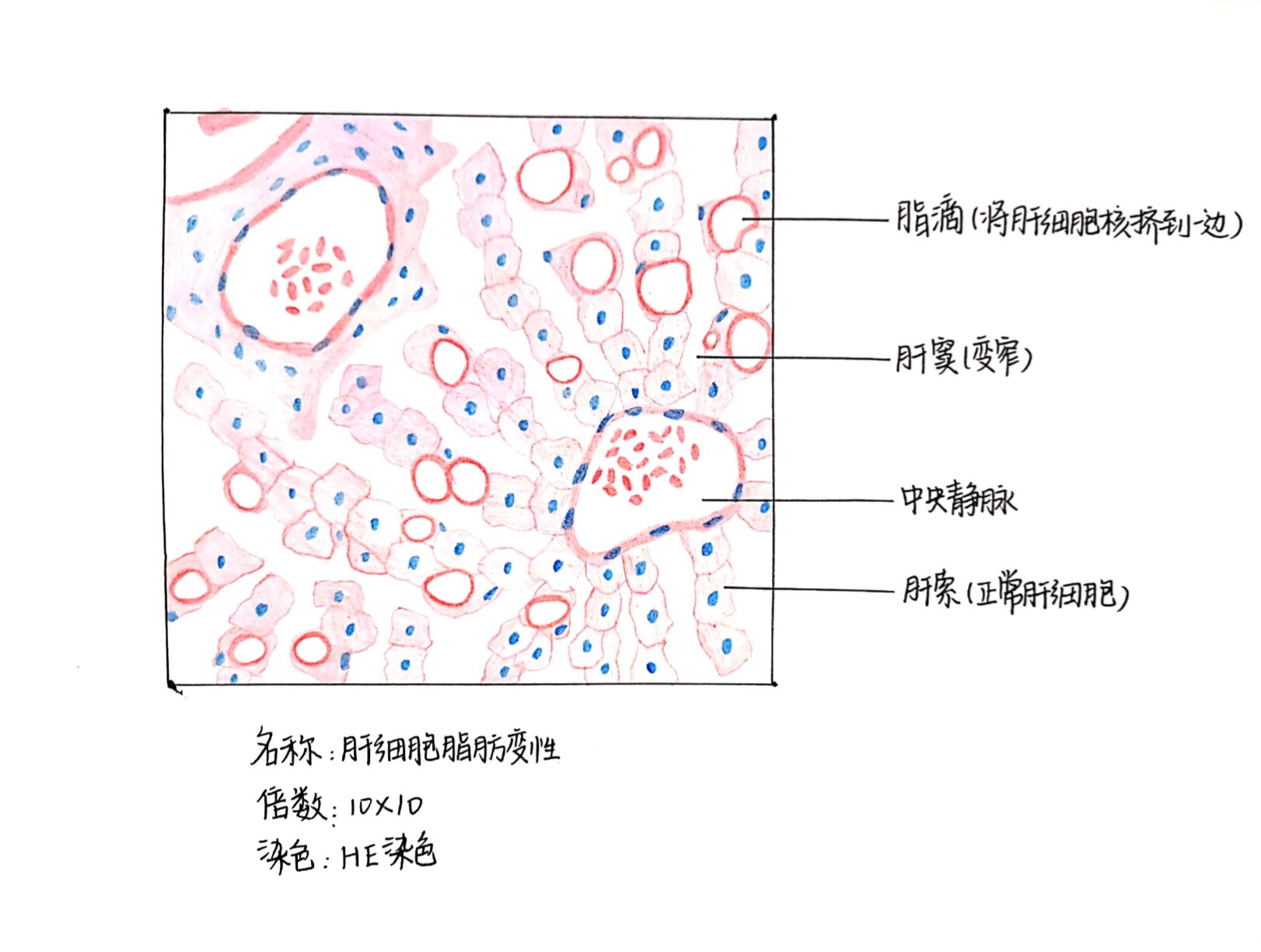 肝脂肪变红蓝手绘图片