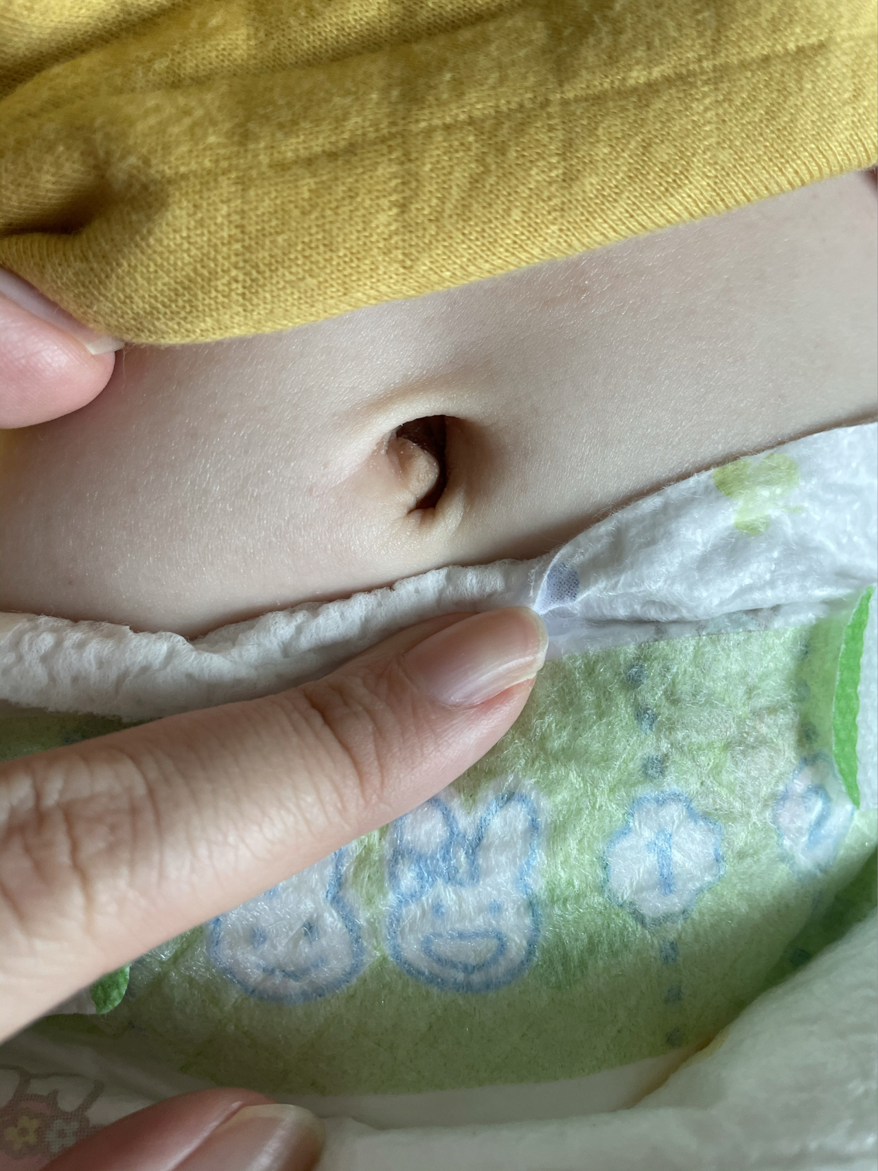 宝宝的肚脐眼正常吗 很想问问小红书里的妈妈们你们的宝宝肚脐眼是