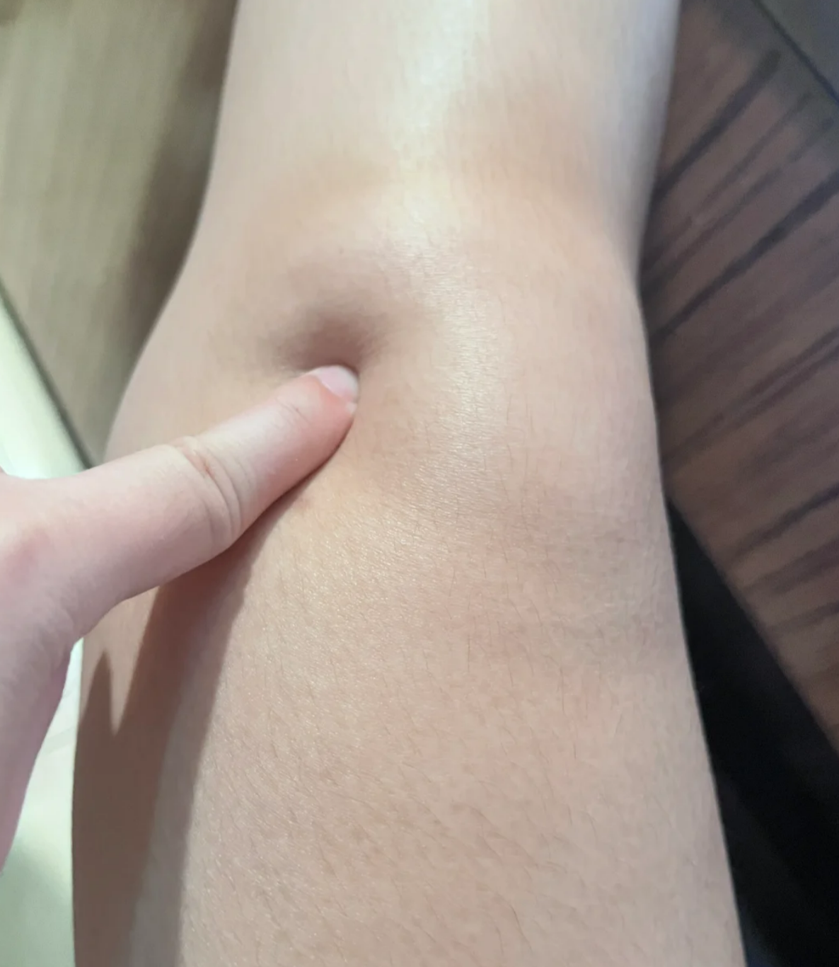 膝盖内侧半月板损伤的典型症状包括疼痛,肿胀,关节响声和交锁征