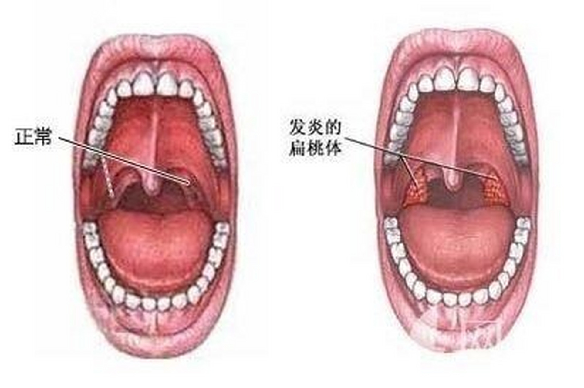 扁桃腺炎症图片