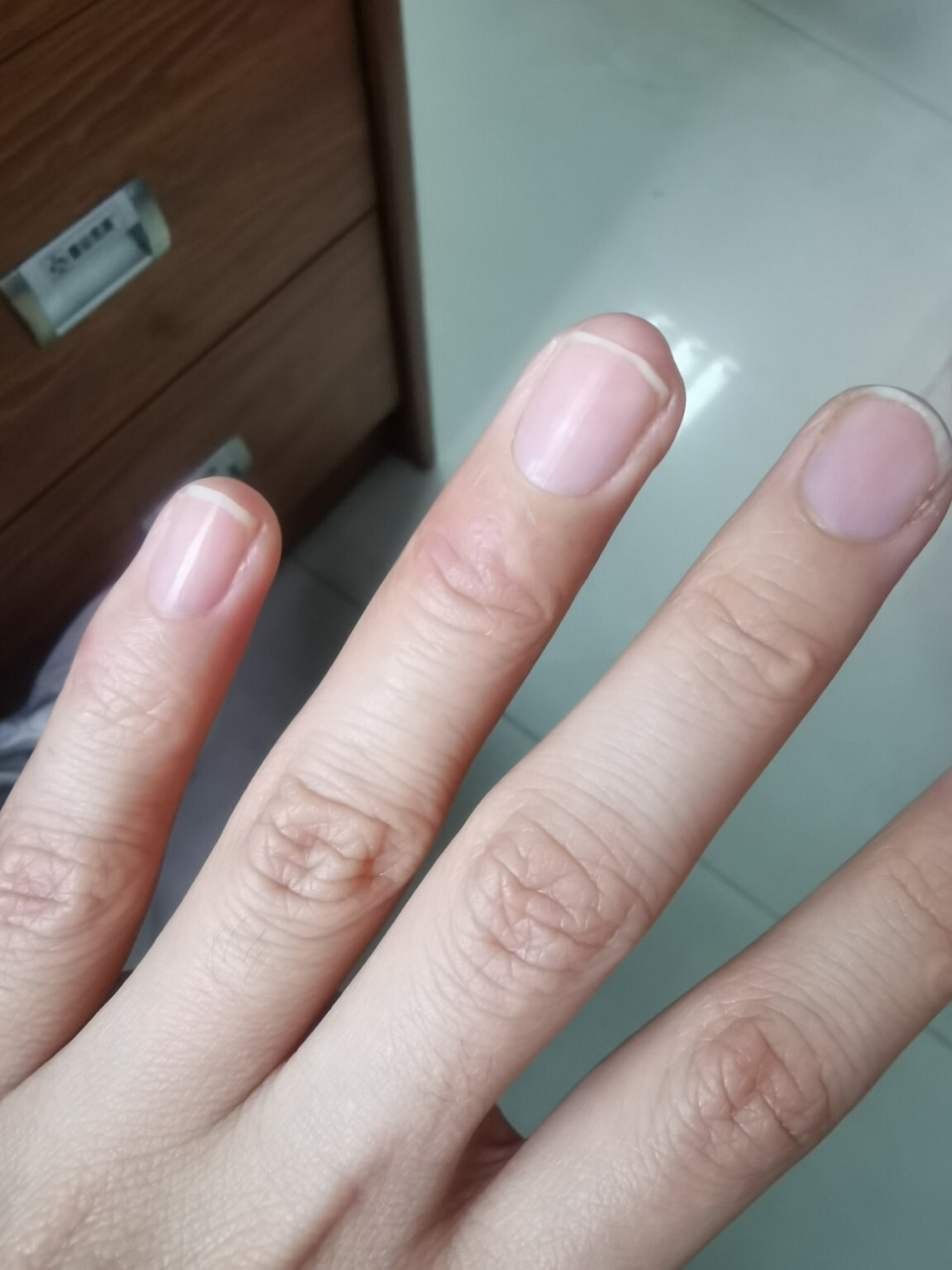 多年的疣终于好了97 家里人说是"鱼鳞痣",多年来反反复复的,每次长