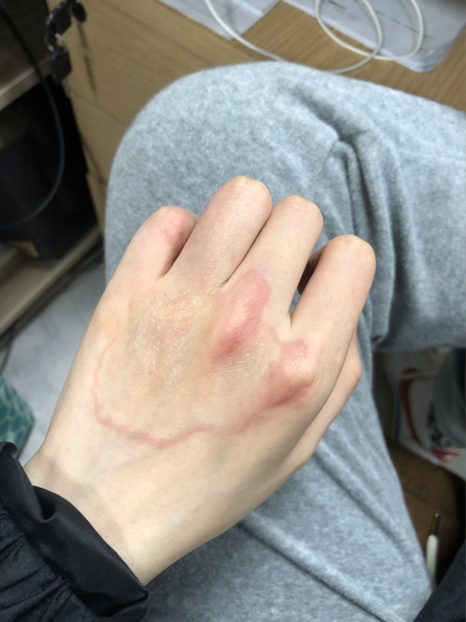 怎么拯救你环形红斑!