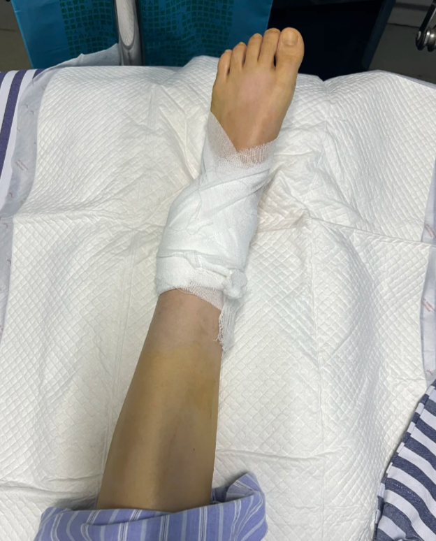 三踝骨折手术后早上脚踝僵硬,常见原因有这几种: