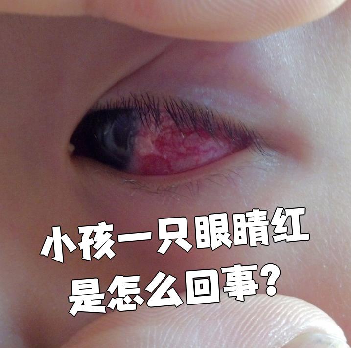 小孩一只眼睛红是怎么回事?