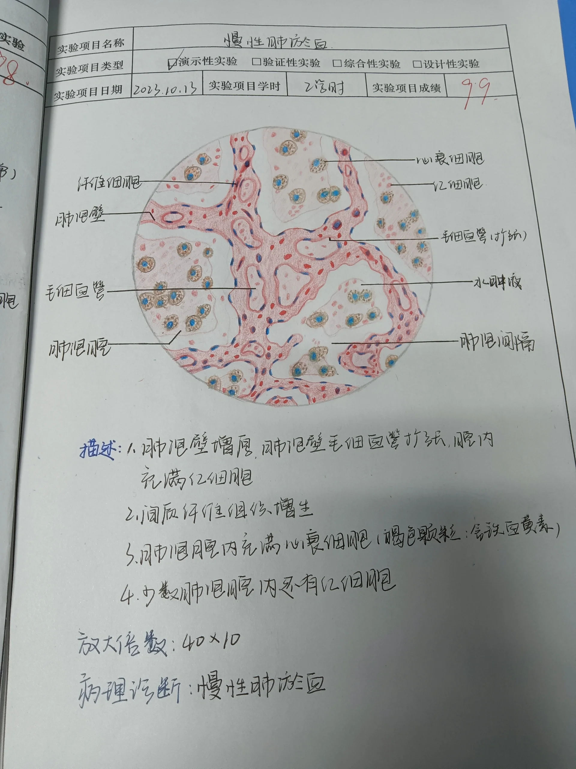 病理 实验报告册-慢性肺淤血 病理 实验报告册-慢性肺淤血