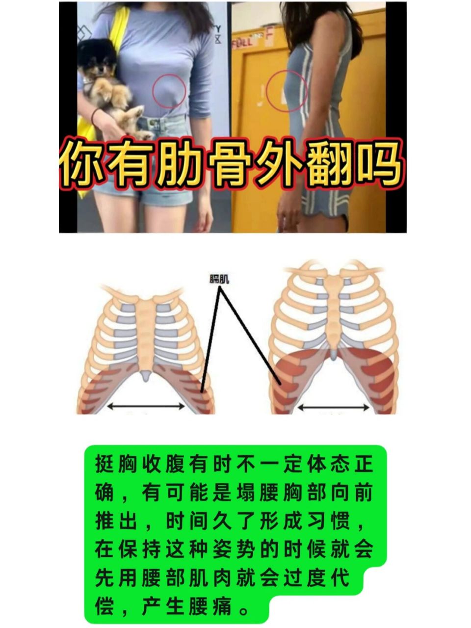 肋骨外翻是由于人的胸骨最下方的两条肋骨不是跟胸骨连在一块的,在