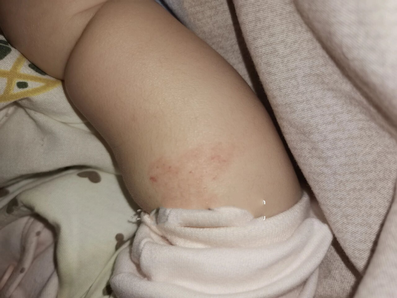 手臂部浅表性血管瘤