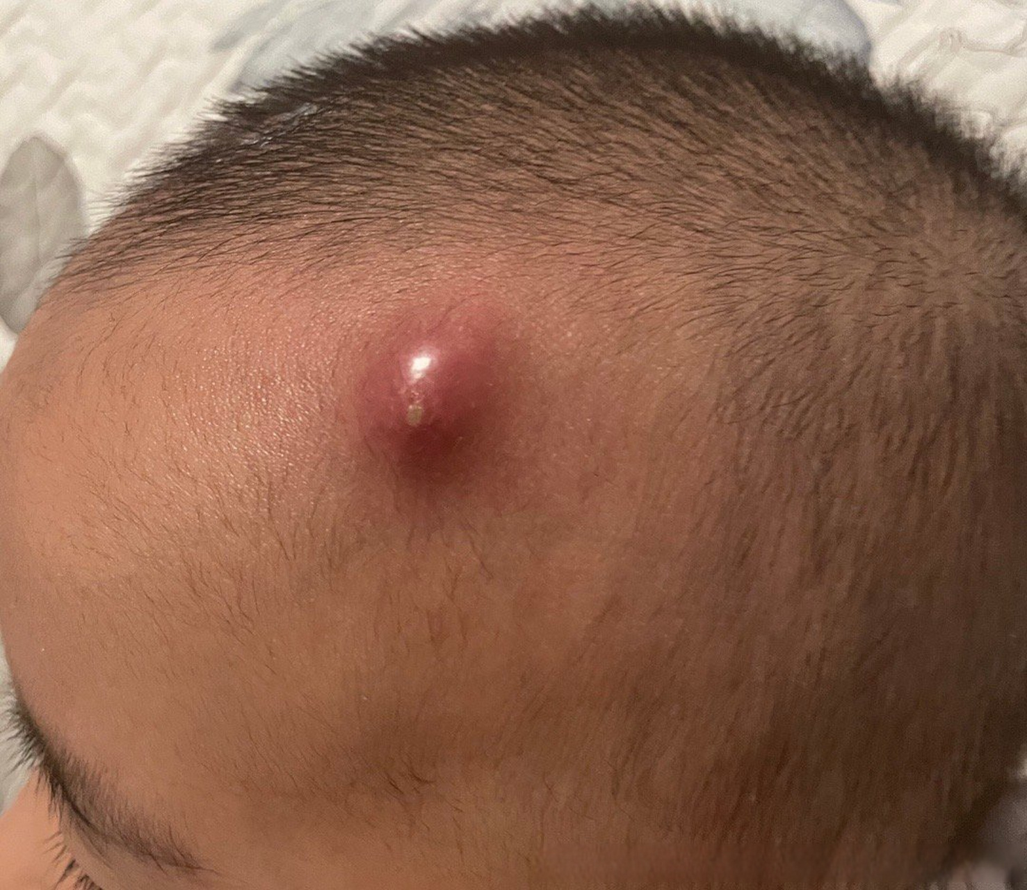 男,2岁,头上散在出现小红疹慢慢越来越大,变红最后有脓头,排浓 消毒