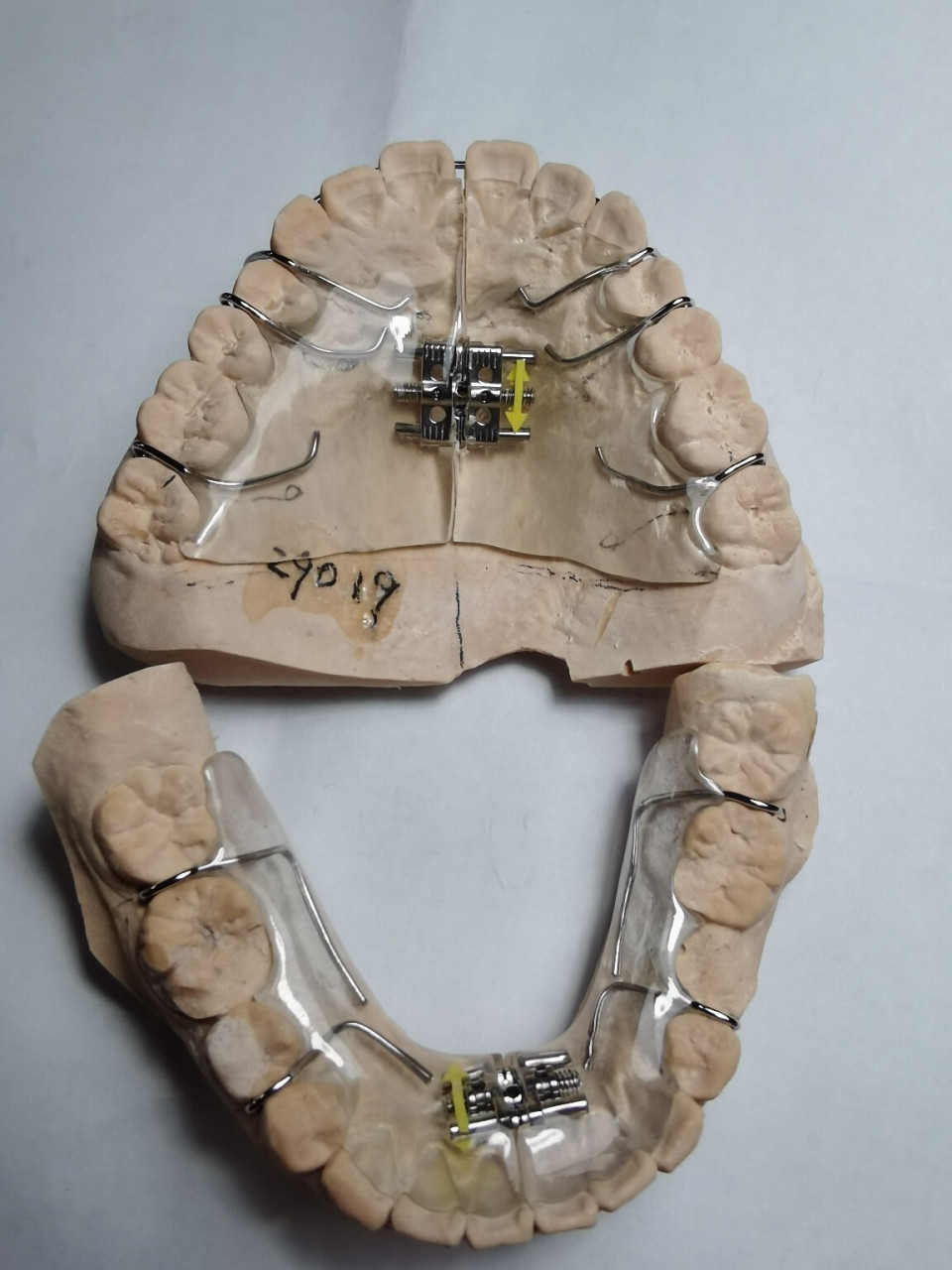 活动螺旋扩弓器 通用型活动扩弓器(基托式)是最常用的螺旋扩弓装置