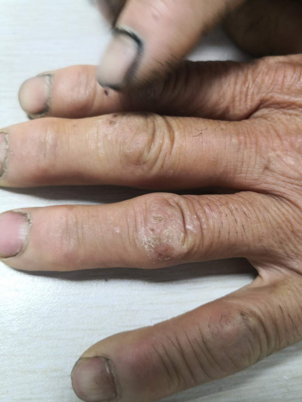 四肢散发的苔藓样变皮疹足跟角化型湿疹症状#解决皮肤问题专注皮肤