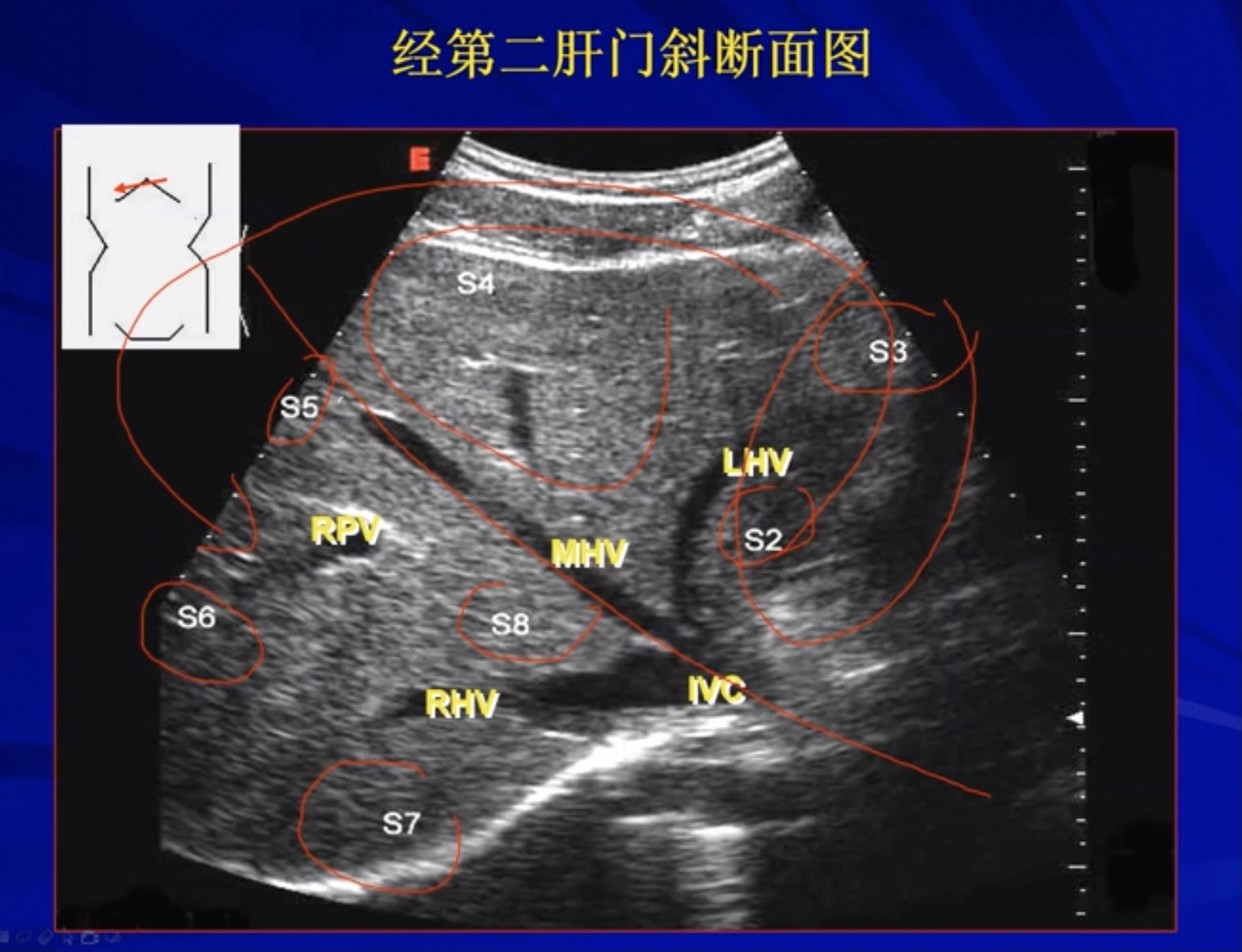 肝脏第一肝门超声图像图片